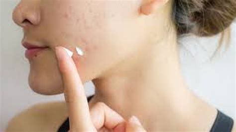 New Study Confirms Cancer Risk In Popular Anti-Acne Products | OnlyMyHealth