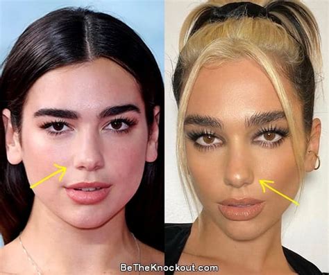 Dua Lipa Plastic Surgery Comparison Photos