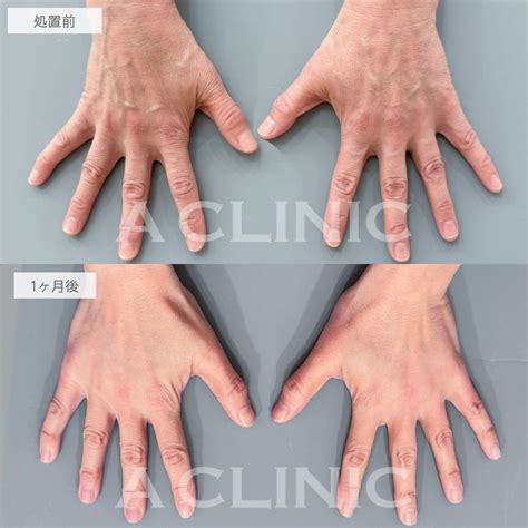 手の甲のヒアルロン酸注入とPRP血小板療法で年齢の出やすい手も若返り！こちら処置前と1ヶ月後の症例です(50代女性) | 美容整形クリニックA ...