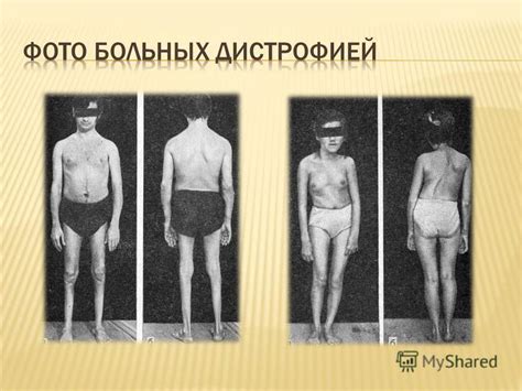 Презентация на тему: "Мышечная дистрофия Дюшенна-Беккера Подготовил ...