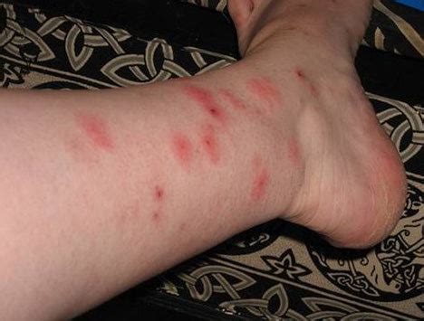 Heat Rash vs. Bed Bugs: How to Tell the Difference