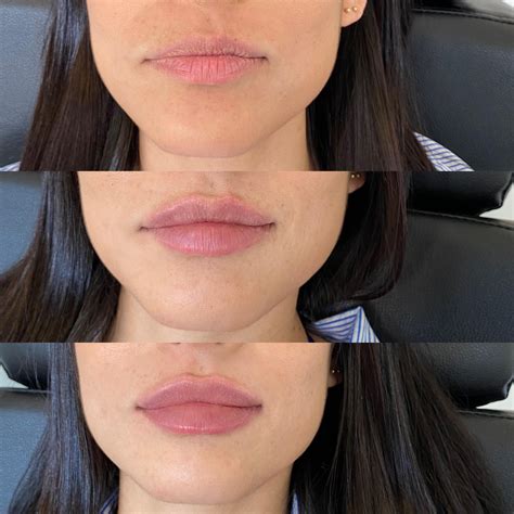 full syringe     lips    danielle