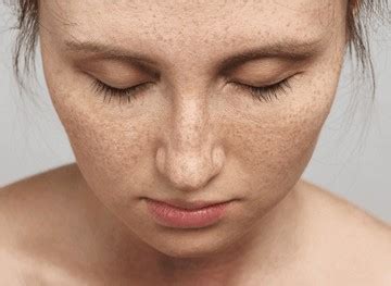 What causes freckles? | Dr Saba Raja aesthetic clinic | Norwich