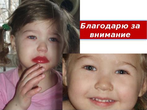 Синдром Кавасаки