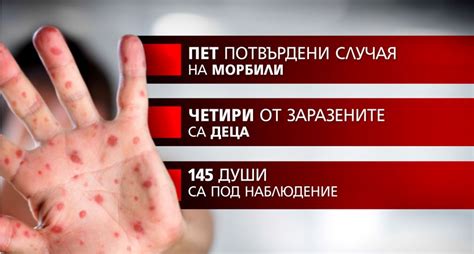 Още 12 деца в Гоце Делчев са със симптоми на морбили | NOVA