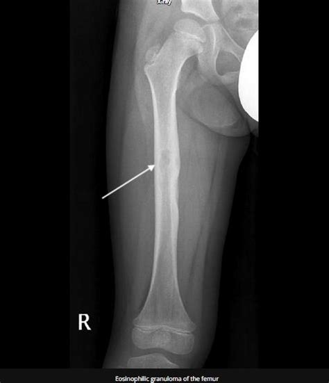 Langerhans Cell Histiocytosis - Pediatrics - Medbullets Step 2/3