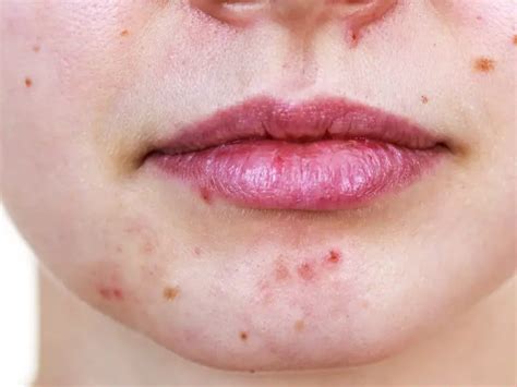 How to Treat and Prevent Acne During Pregnancy