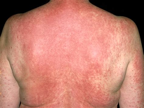 Photos Reaction To Use Skin Rash Urticaria Allergic S - vrogue.co