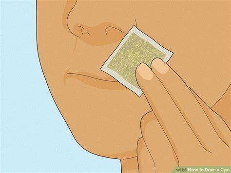 how to freeze a cyst at home