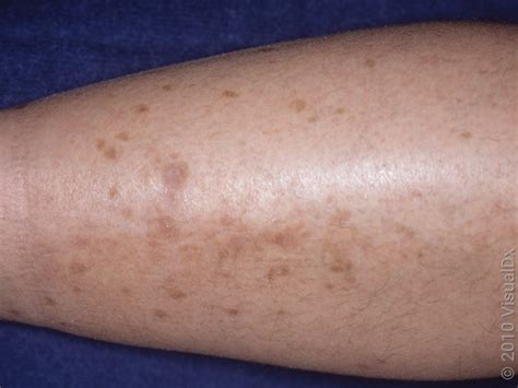 early signs  diabetes  pictures goodrx