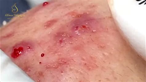 Unbelievable Blackhead Removal 2024: The Ultimate Guide for Clear Skin - v92jr6p
