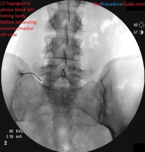 Hypogastric Plexus Block - Technique and Overview - The Procedure Guide