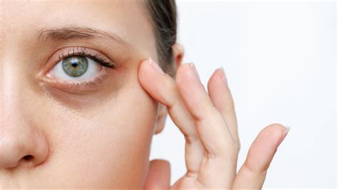 Rejuran for dark circles Melbourne - Rejuran I eye before and after