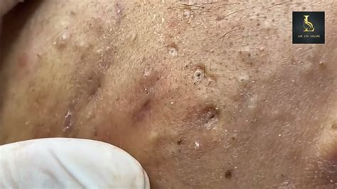 8 Unbelievable Blackhead Removal Tips You've Probably Never Heard Of (2024) - u5wxeb6