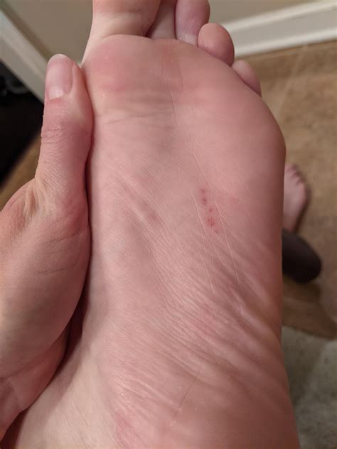 Itchy bottom of foot : r/Dyshidrosis