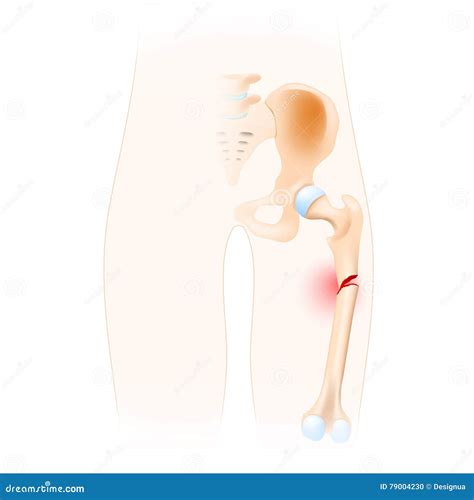 Fractured Femur stock vector. Illustration of medicine - 79004230