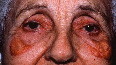 periorbital_xanthogranulomas_rd