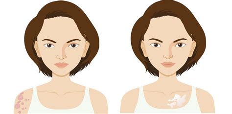 Doenca Lúpus Psoriase E Vitiligo Sao Exemplos - Psoríase e Vitiligo: entenda a diferença