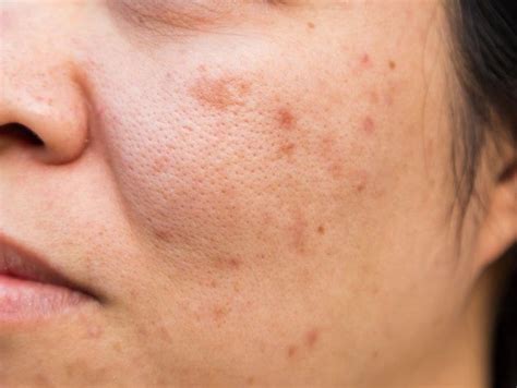 Problemas na pele do rosto é acne e manchas. | Foto Premium | Pele do ...