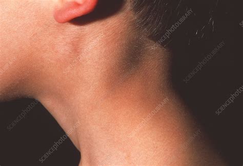 Swollen