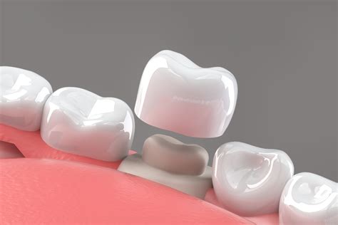 Anterior Crowns - Chestnut Ridge Dental