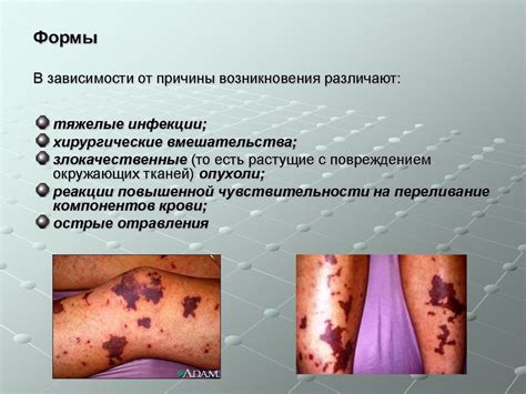 ДВС-синдром - online presentation