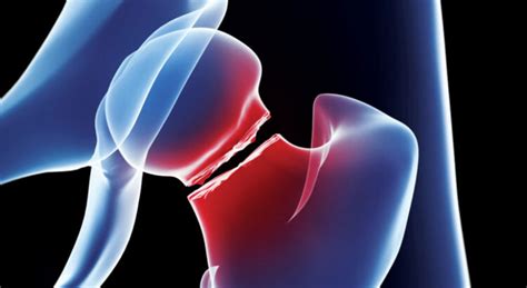 Introduction of Fragility Fracture Program | Clinical Performance