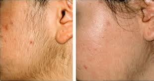 Permanent Hair Removal – Shanti Skin Care