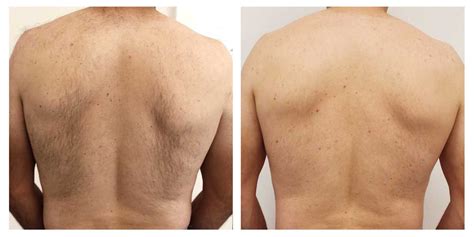 IPL hair removal permanent hair reduction - theGoodSkinPlace