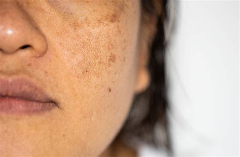 cosmelan ageless clinic