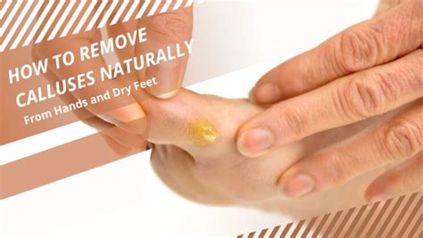 9 Tips for How To Remove Calluses Naturally From Hands and Dry Feet ...