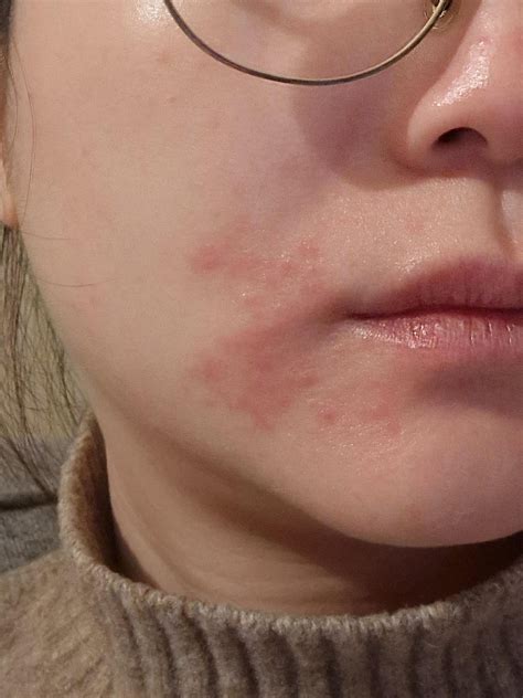 Winter rash? : r/Rosacea