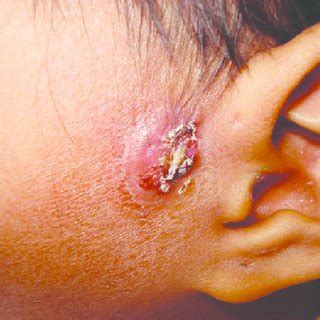 Chronic cutaneous-disseminated sporotrichosis. | Download Scientific ...