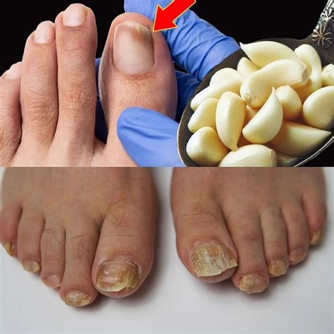 This Is a Nail Fungus Killer! 🦶💥 It Works Very Fast – Just Use Garlic! 🧄