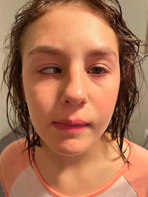 Stiff Person Syndrome Affects