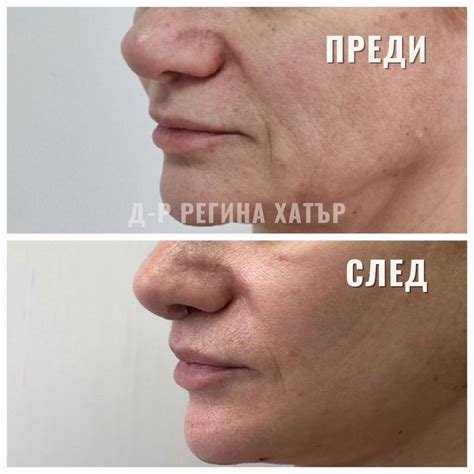 Преди и след липлифт. След само 14... - Д-р Регина Хатър