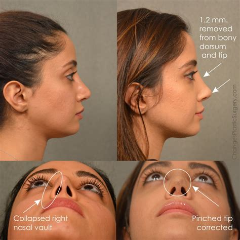 nose job   tip  luca glossop blog