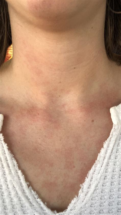 Food Intolerance? Sometimes after I eat a meal I break out in a red