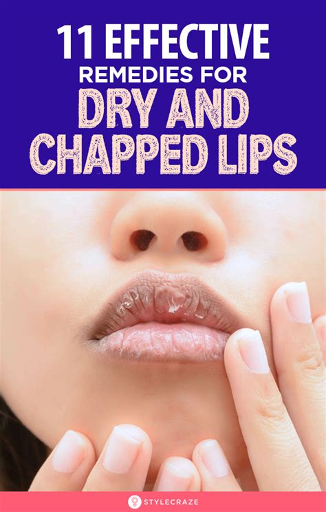 11 Home Remedies To Get Rid Of Chapped Lips Fast - How Can This