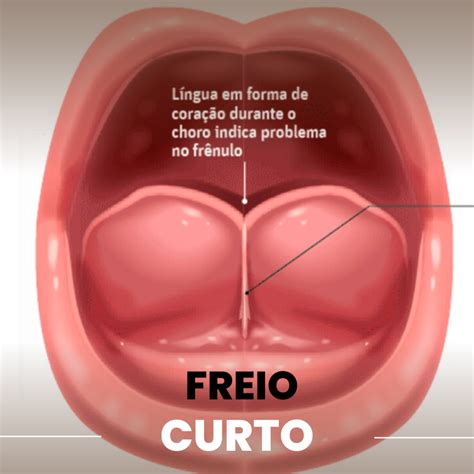 Freio Da Lingua Machucado - Freio da língua curto: como pode impactar na amamentação? - Meu Bebê Care
