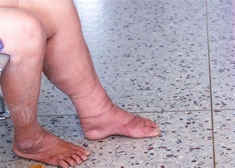 lymphedema treatment   symptoms