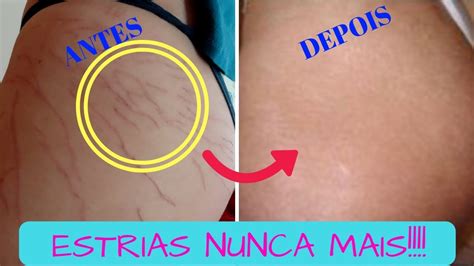 Como Acabar Com A Estria
