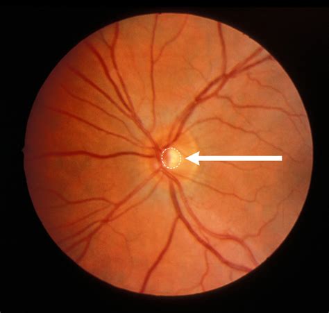 ch   glaucoma eye  patients guide  glaucoma