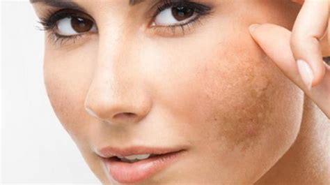 Blemishes on Skin