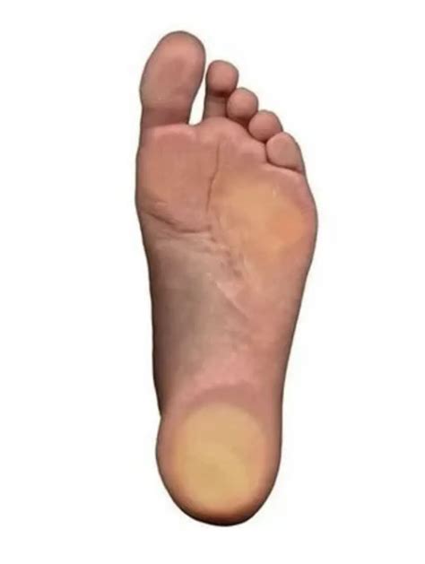 Flat Foot for Philadelphia, PA | Frankford Podiatry Associates, PC