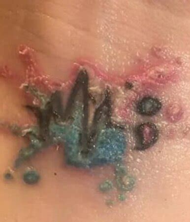 how to treat tattoo infection at home