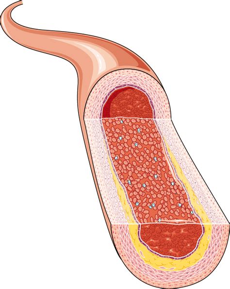 Atheroma - Servier Medical Art