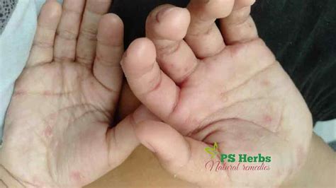 penyakit kudis buta bahaya tapi mudah sembuh ps herbs