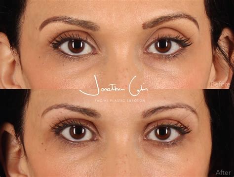 upper eyelid contouring cabinmd facial plastics aesthetics
