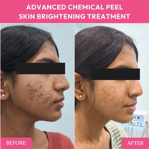 Chemical Peels vs. Laser Treatment | Best for Acne Scars
